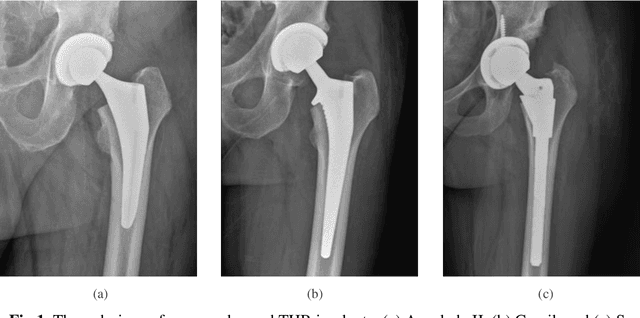 Figure 2 for Detecting total hip replacement prosthesis design on preoperative radiographs using deep convolutional neural network