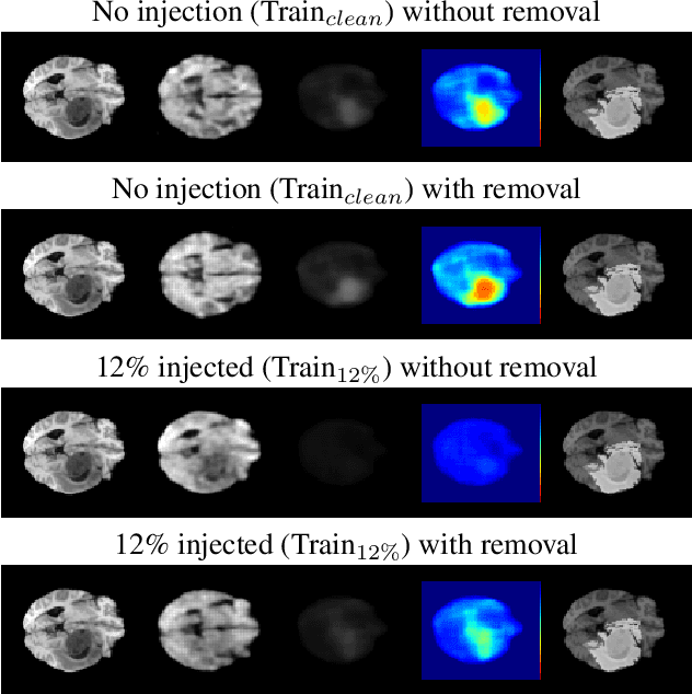 Figure 3 for Unsupervised Anomaly Detection in 3D Brain MRI using Deep Learning with impured training data