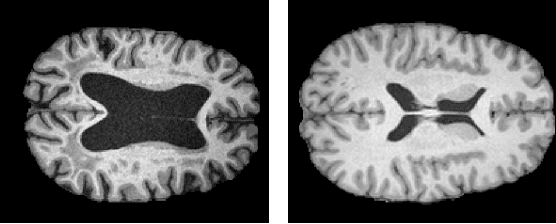 Figure 4 for Unsupervised Anomaly Detection in 3D Brain MRI using Deep Learning with impured training data