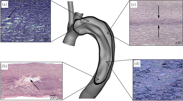 Figure 1 for Stochastic Modeling of Inhomogeneities in the Aortic Wall and Uncertainty Quantification using a Bayesian Encoder-Decoder Surrogate