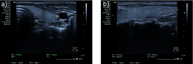 Figure 3 for Tracked 3D Ultrasound and Deep Neural Network-based Thyroid Segmentation reduce Interobserver Variability in Thyroid Volumetry