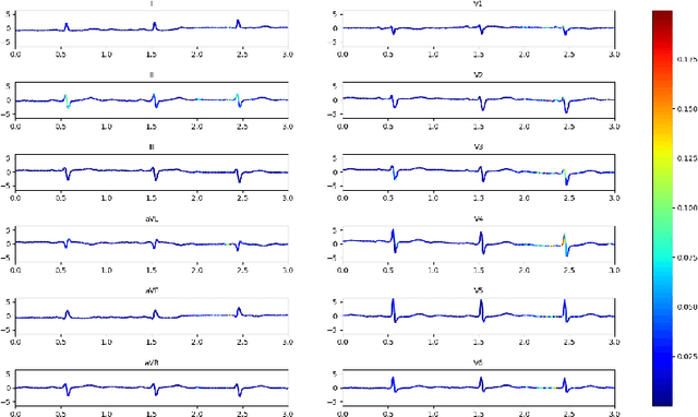 Figure 4 for SIM-ECG: A Signal Importance Mask-driven ECGClassification System