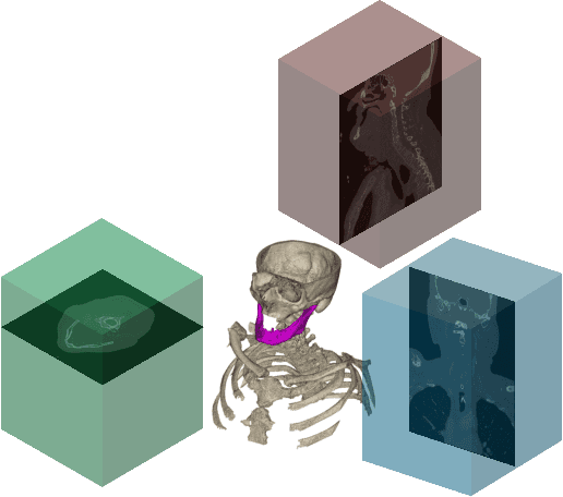 Figure 2 for 3D segmentation of mandible from multisectional CT scans by convolutional neural networks
