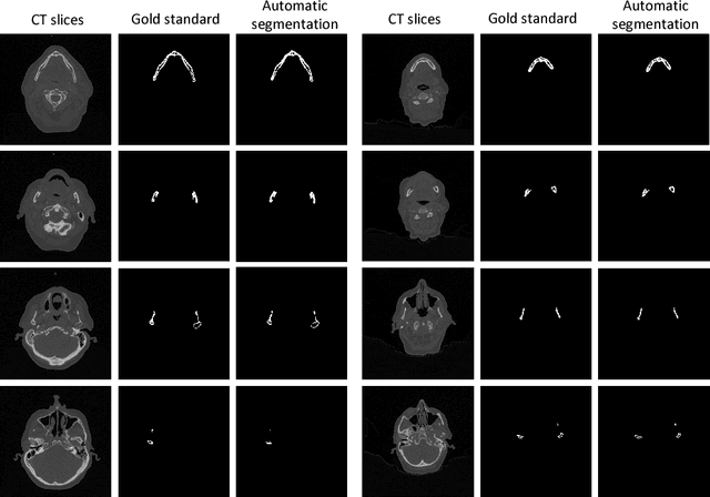 Figure 3 for 3D segmentation of mandible from multisectional CT scans by convolutional neural networks