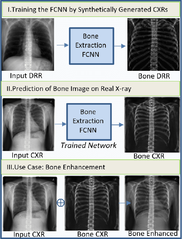 Figure 1 for Bone Structures Extraction and Enhancement in Chest Radiographs via CNN Trained on Synthetic Data