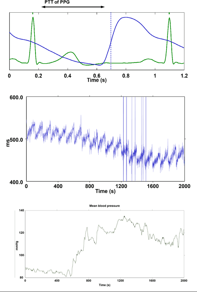 Figure 1 for Calibration for massive physiological signal collection in hospital -- Sawtooth artifact in beat-to-beat pulse transit time measured from patient monitor data