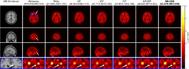 Figure 4 for Anatomical-Guided Attention Enhances Unsupervised PET Image Denoising Performance