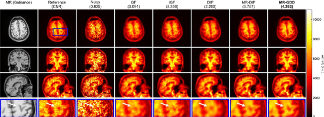 Figure 3 for Anatomical-Guided Attention Enhances Unsupervised PET Image Denoising Performance