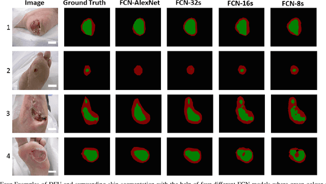 Figure 4 for Fully Convolutional Networks for Diabetic Foot Ulcer Segmentation