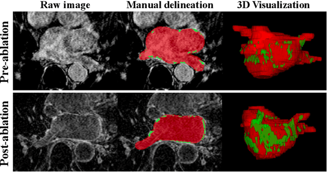 Figure 1 for JAS-GAN: Generative Adversarial Network Based Joint Atrium and Scar Segmentations on Unbalanced Atrial Targets