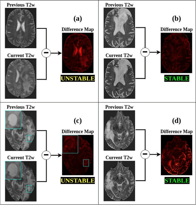 Figure 2 for Transfer learning with weak labels from radiology reports: application to glioma change detection