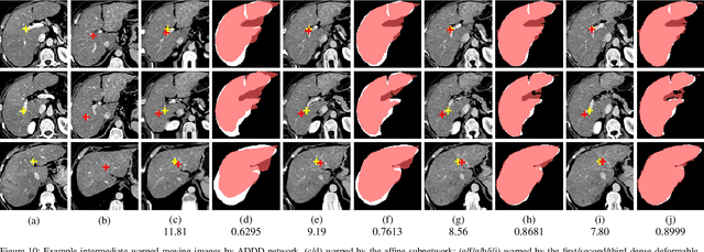 Figure 2 for Unsupervised 3D End-to-End Medical Image Registration with Volume Tweening Network