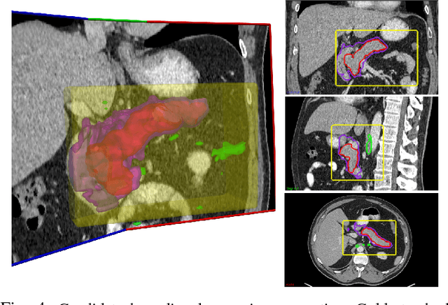 Figure 4 for Spatial Aggregation of Holistically-Nested Convolutional Neural Networks for Automated Pancreas Localization and Segmentation