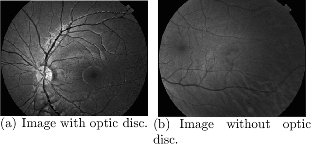 Figure 4 for A Fast and Effective Method of Macula Automatic Detection for Retina Images