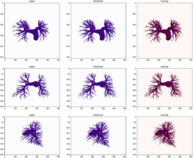 Figure 2 for PARSE challenge 2022: Pulmonary Arteries Segmentation using Swin U-Net Transformer(Swin UNETR) and U-Net