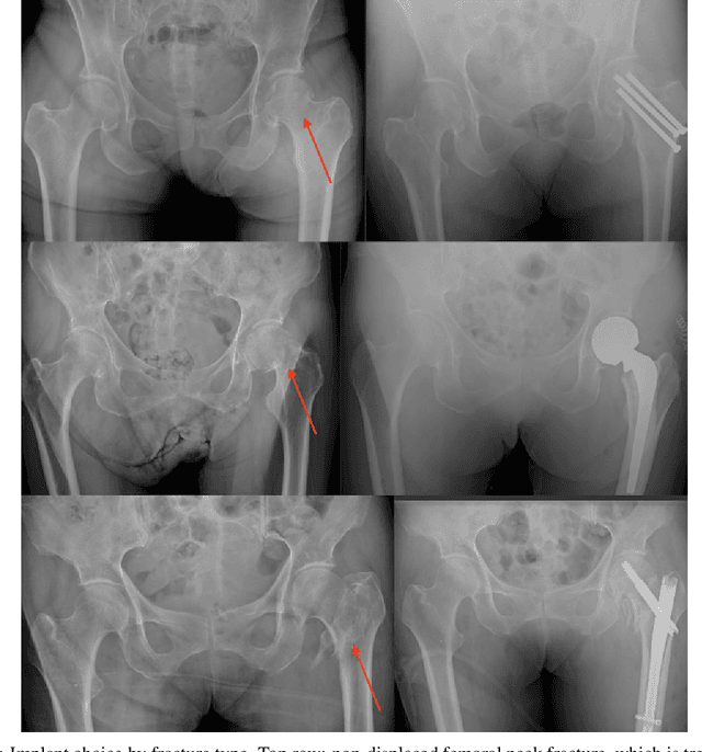 Figure 1 for Automatic Hip Fracture Identification and Functional Subclassification with Deep Learning