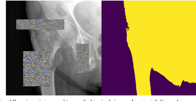 Figure 4 for Automatic Hip Fracture Identification and Functional Subclassification with Deep Learning