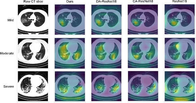 Figure 4 for Dual-Attention Residual Network for Automatic Diagnosis of COVID-19