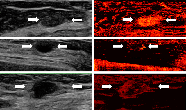 Figure 2 for Learned super resolution ultrasound for improved breast lesion characterization