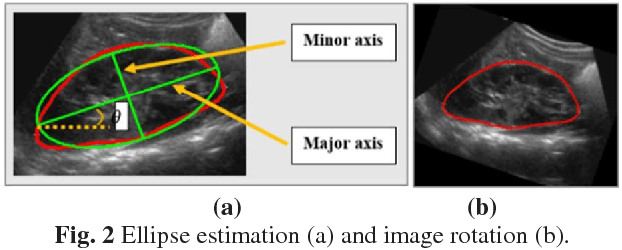 Figure 2 for Transfer learning for diagnosis of congenital abnormalities of the kidney and urinary tract in children based on Ultrasound imaging data