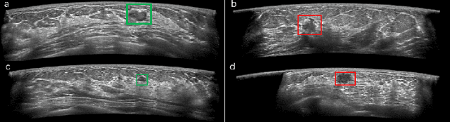 Figure 1 for Computer-aided Tumor Diagnosis in Automated Breast Ultrasound using 3D Detection Network
