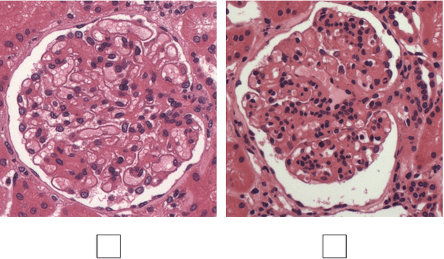 Figure 1 for Classification of glomerular hypercellularity using convolutional features and support vector machine