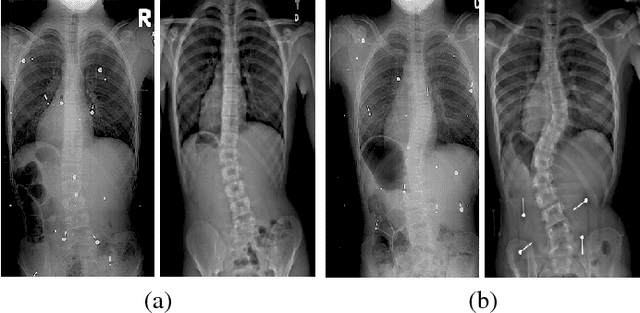 Figure 1 for 3D Morphology Prediction of Progressive Spinal Deformities from Probabilistic Modeling of Discriminant Manifolds
