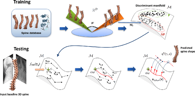 Figure 2 for 3D Morphology Prediction of Progressive Spinal Deformities from Probabilistic Modeling of Discriminant Manifolds