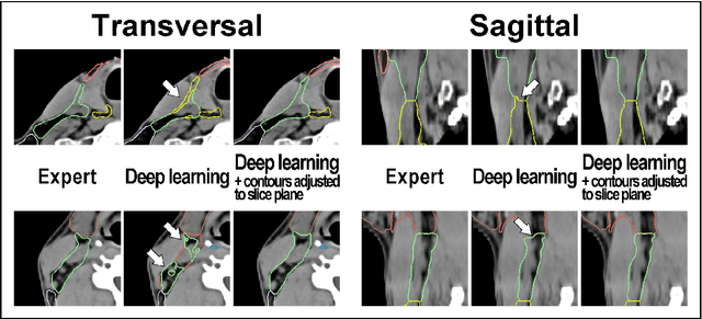 Figure 2 for Deep Learning for automatic head and neck lymph node level delineation