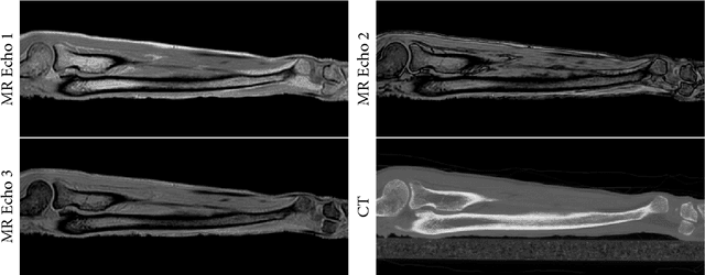Figure 3 for CT synthesis from MR images for orthopedic applications in the lower arm using a conditional generative adversarial network