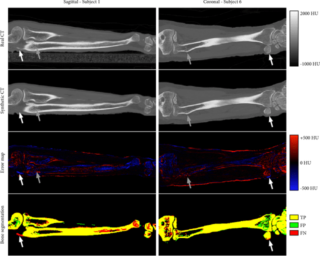Figure 4 for CT synthesis from MR images for orthopedic applications in the lower arm using a conditional generative adversarial network