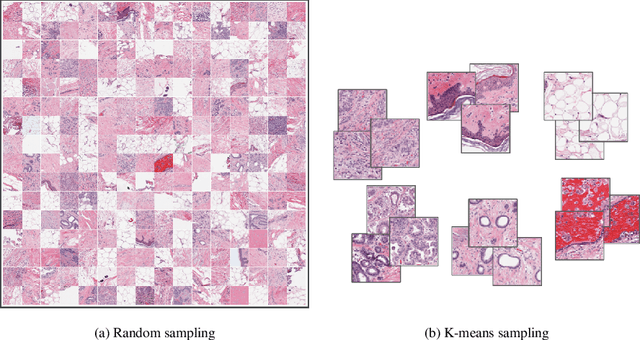 Figure 1 for Overcoming the limitations of patch-based learning to detect cancer in whole slide images