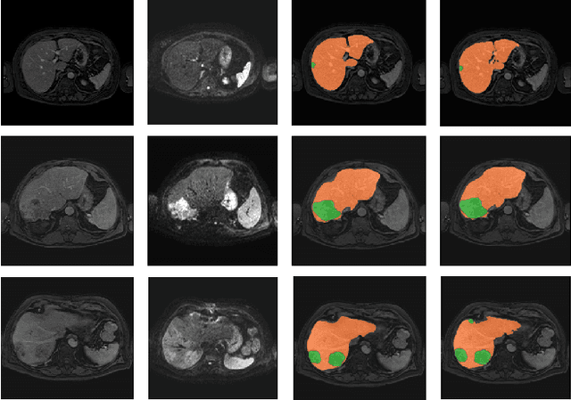Figure 4 for Liver segmentation and metastases detection in MR images using convolutional neural networks