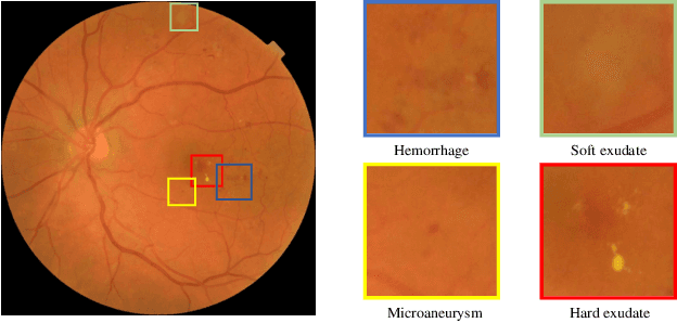 Figure 1 for Lesion-based Contrastive Learning for Diabetic Retinopathy Grading from Fundus Images
