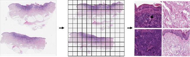 Figure 1 for Detecting cutaneous basal cell carcinomas in ultra-high resolution and weakly labelled histopathological images