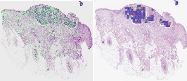 Figure 3 for Detecting cutaneous basal cell carcinomas in ultra-high resolution and weakly labelled histopathological images