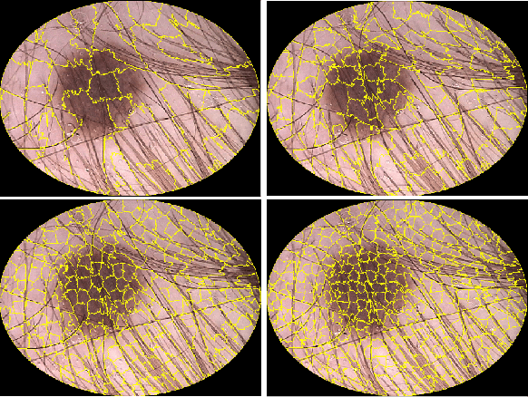 Figure 1 for Automatic skin lesion segmentation on dermoscopic images by the means of superpixel merging