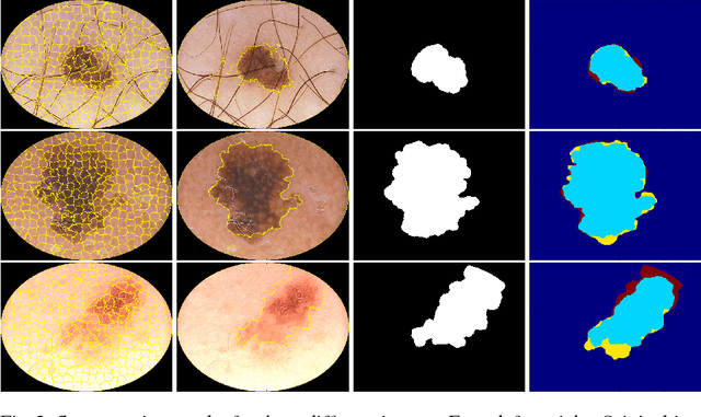 Figure 3 for Automatic skin lesion segmentation on dermoscopic images by the means of superpixel merging
