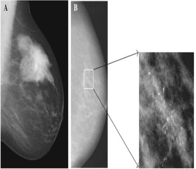 Figure 3 for Artificial Neural Network Based Breast Cancer Screening: A Comprehensive Review