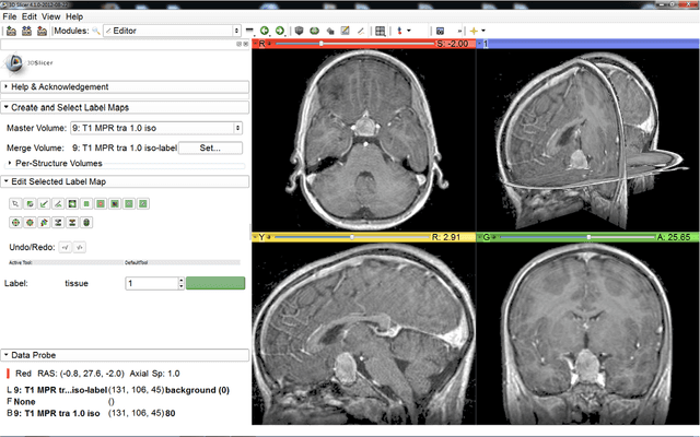 Figure 1 for Pituitary Adenoma Volumetry with 3D Slicer