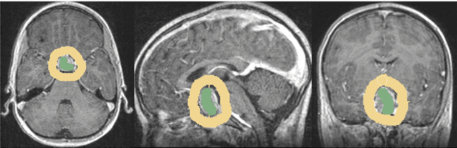 Figure 3 for Pituitary Adenoma Volumetry with 3D Slicer