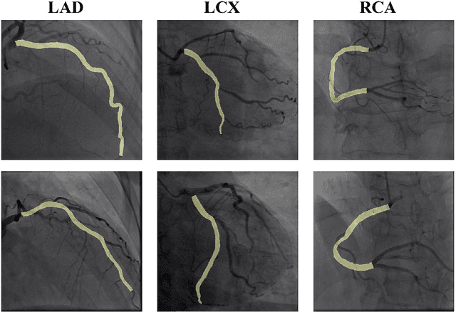 Figure 1 for T-Net: Encoder-Decoder in Encoder-Decoder architecture for the main vessel segmentation in coronary angiography