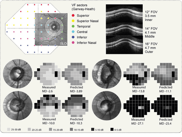 Figure 1 for Pointwise visual field estimation from optical coherence tomography in glaucoma: a structure-function analysis using deep learning