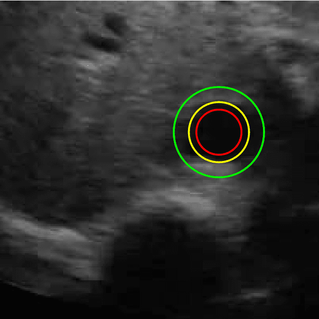 Figure 1 for Estimation and Tracking of AP-diameter of the Inferior Vena Cava in Ultrasound Images Using a Novel Active Circle Algorithm