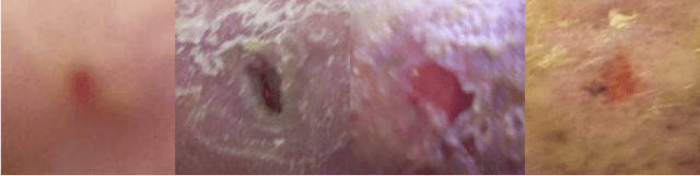 Figure 1 for Hybrid Classical-Quantum method for Diabetic Foot Ulcer Classification