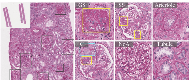 Figure 1 for Automatic Fine-grained Glomerular Lesion Recognition in Kidney Pathology