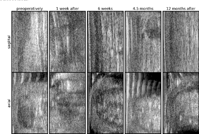 Figure 1 for Monitoring Achilles tendon healing progress in ultrasound imaging with convolutional neural networks