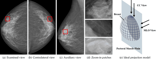 Figure 1 for Act Like a Radiologist: Towards Reliable Multi-view Correspondence Reasoning for Mammogram Mass Detection