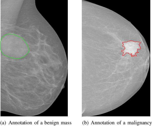 Figure 1 for Dual Convolutional Neural Networks for BreastMass Segmentation and Diagnosis inMammography