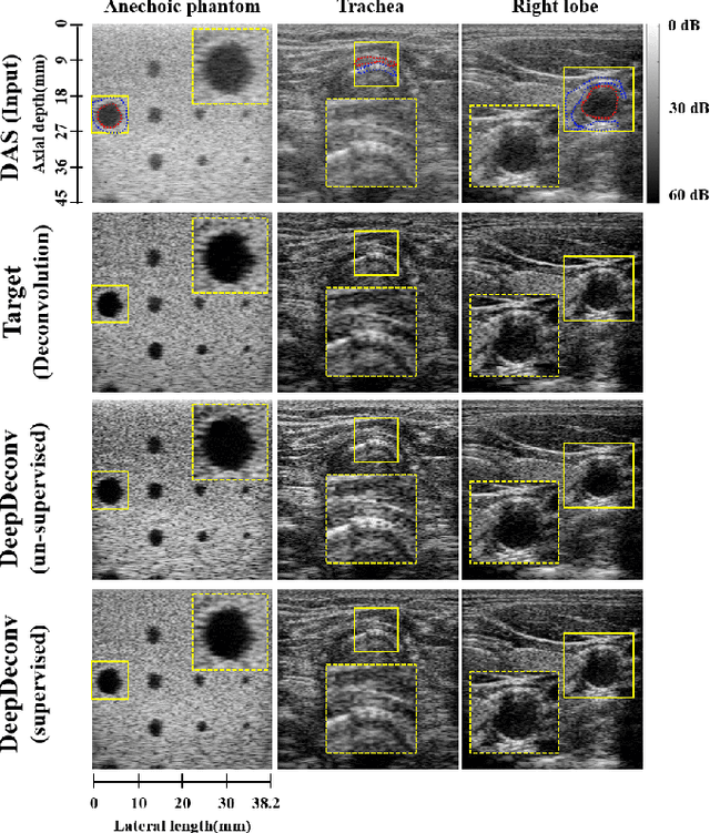 Figure 3 for Pushing the Limit of Unsupervised Learning for Ultrasound Image Artifact Removal